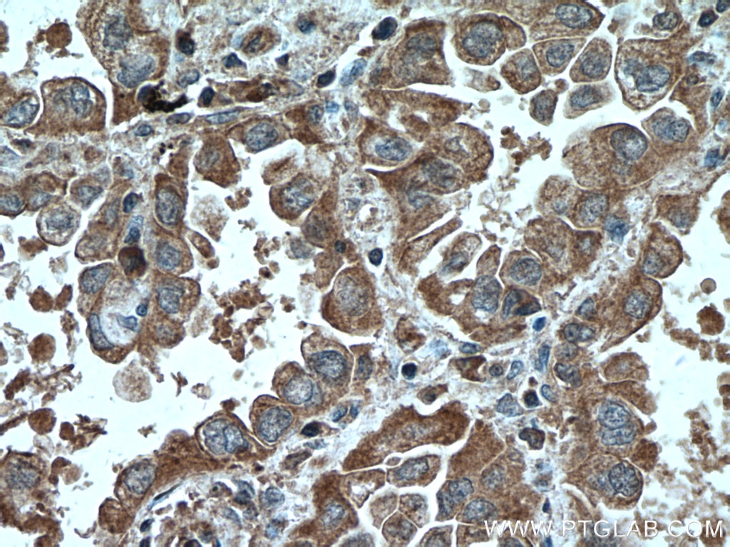 Immunohistochemistry (IHC) staining of human lung cancer tissue using CHST4 Monoclonal antibody (66623-1-Ig)