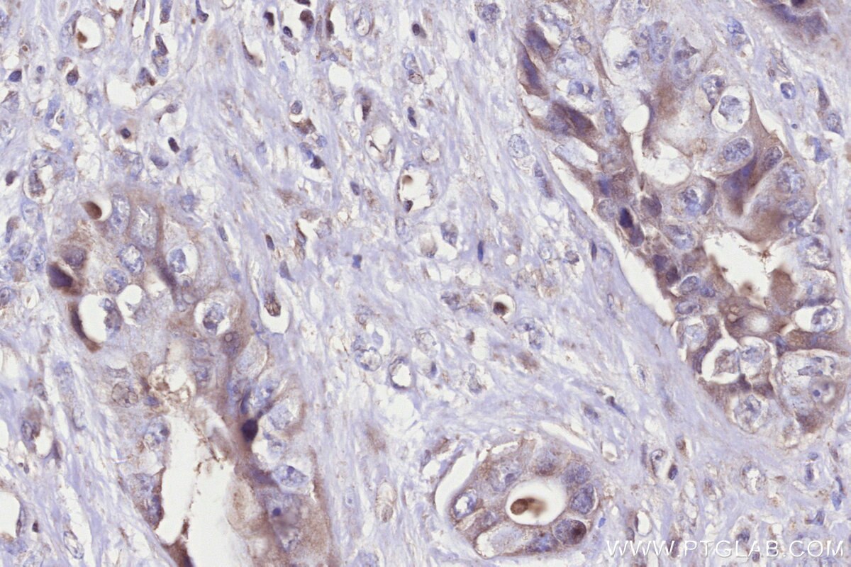 Immunohistochemistry (IHC) staining of human pancreas cancer tissue using CHST4 Monoclonal antibody (66623-1-Ig)