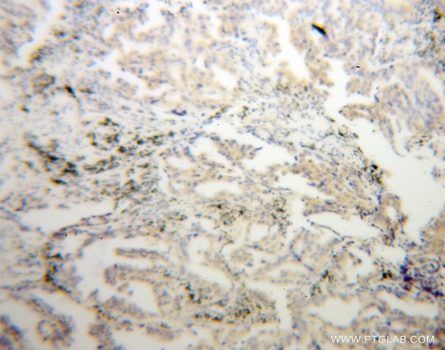 Immunohistochemistry (IHC) staining of human lung cancer tissue using CHSY1 Polyclonal antibody (14420-1-AP)