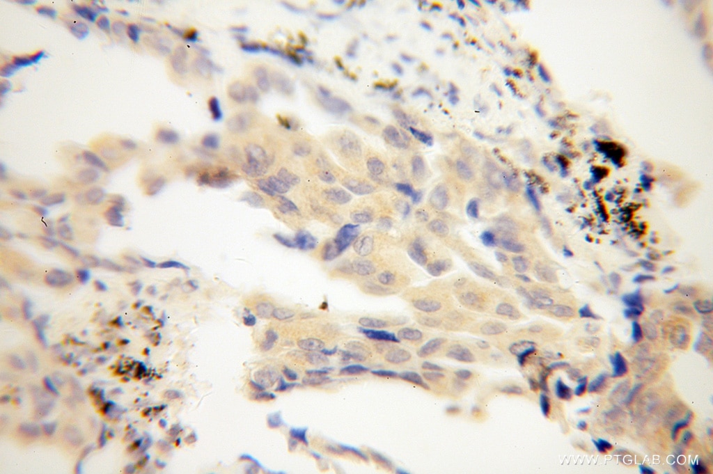 Immunohistochemistry (IHC) staining of human lung cancer tissue using CHSY1 Polyclonal antibody (14420-1-AP)