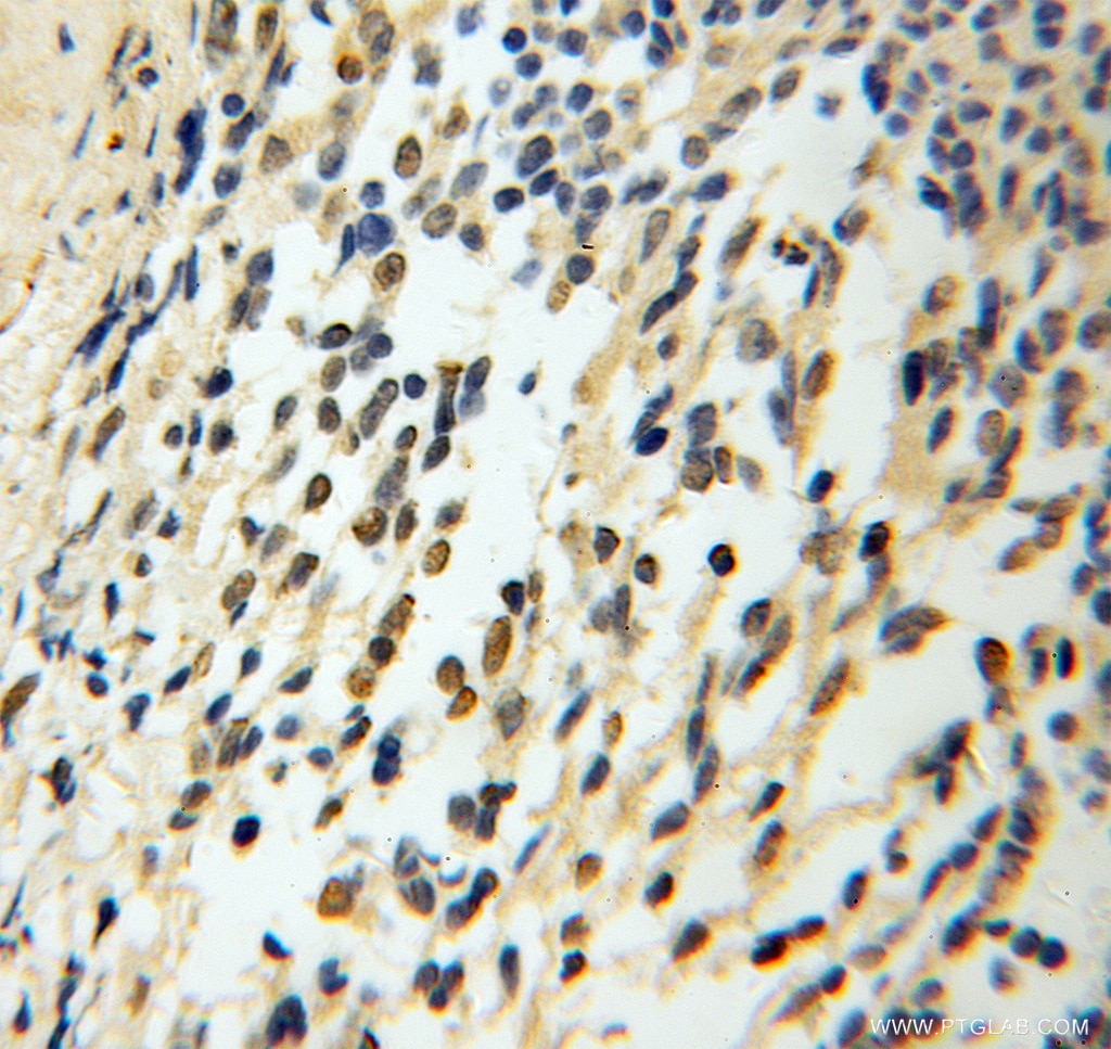 IHC staining of human medulloblastoma using 13030-1-AP