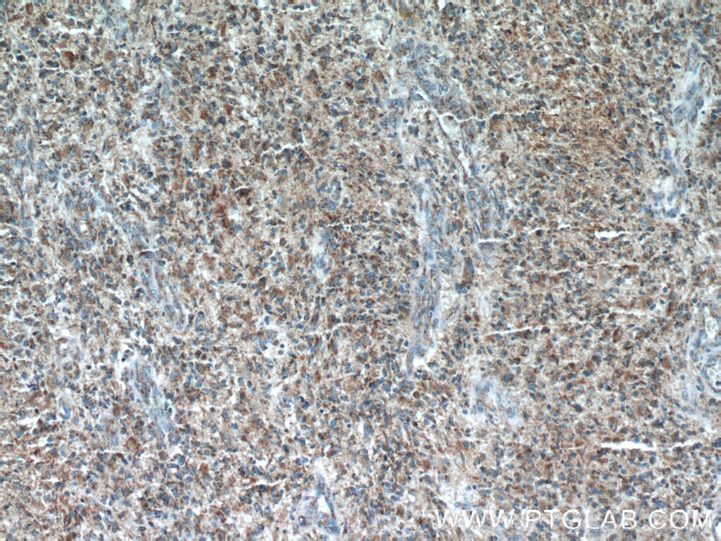 Immunohistochemistry (IHC) staining of human gliomas tissue using CHURC1 Polyclonal antibody (12247-1-AP)