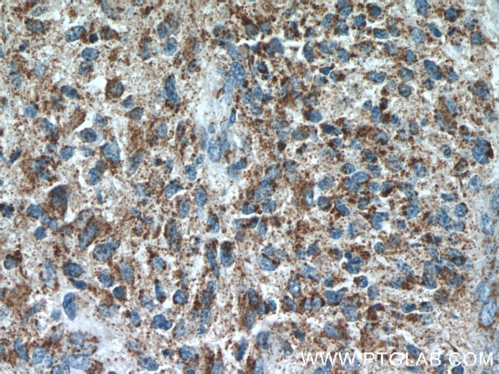 Immunohistochemistry (IHC) staining of human gliomas tissue using CHURC1 Polyclonal antibody (12247-1-AP)