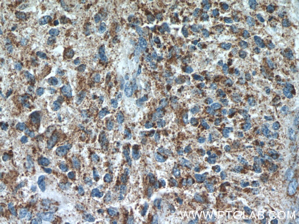 IHC staining of human gliomas using 12247-1-AP