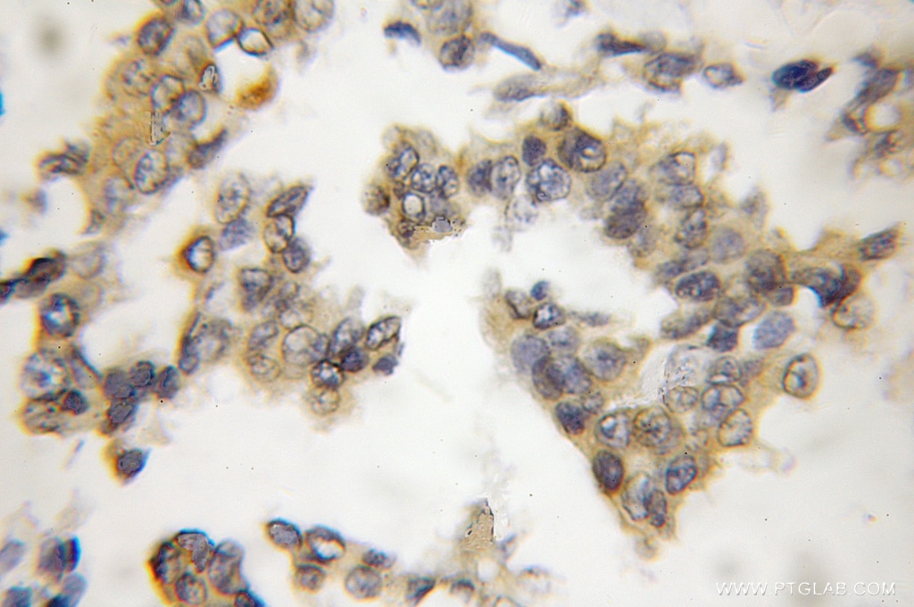 IHC staining of human breast cancer using 11823-1-AP