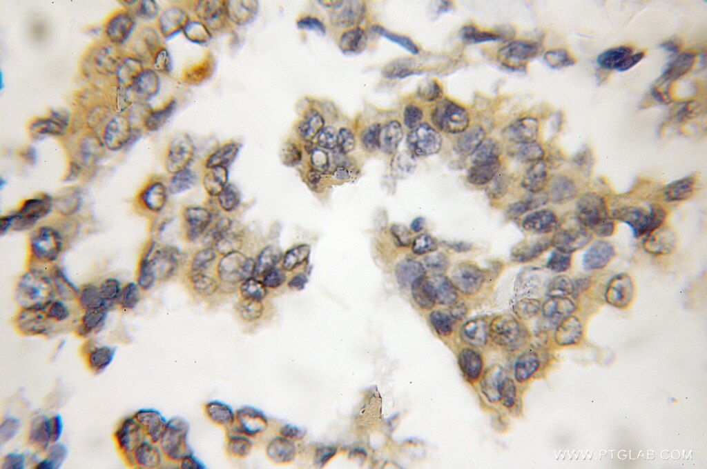 Immunohistochemistry (IHC) staining of human breast cancer tissue using CIB1 Polyclonal antibody (11823-1-AP)