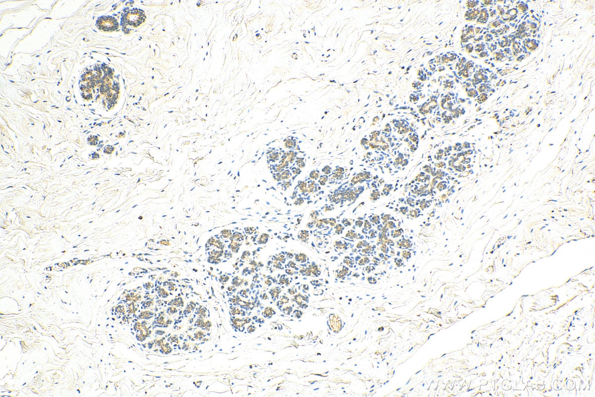 Immunohistochemistry (IHC) staining of human breast cancer tissue using CIB1 Monoclonal antibody (67901-1-Ig)