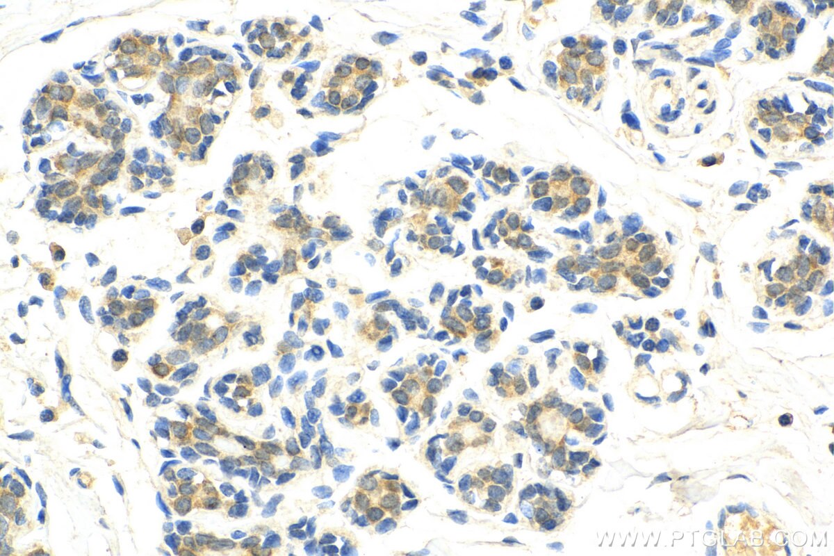 Immunohistochemistry (IHC) staining of human breast cancer tissue using CIB1 Monoclonal antibody (67901-1-Ig)