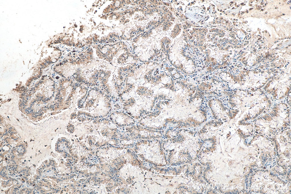 Immunohistochemistry (IHC) staining of human lung cancer tissue using CIP2A Polyclonal antibody (23199-1-AP)