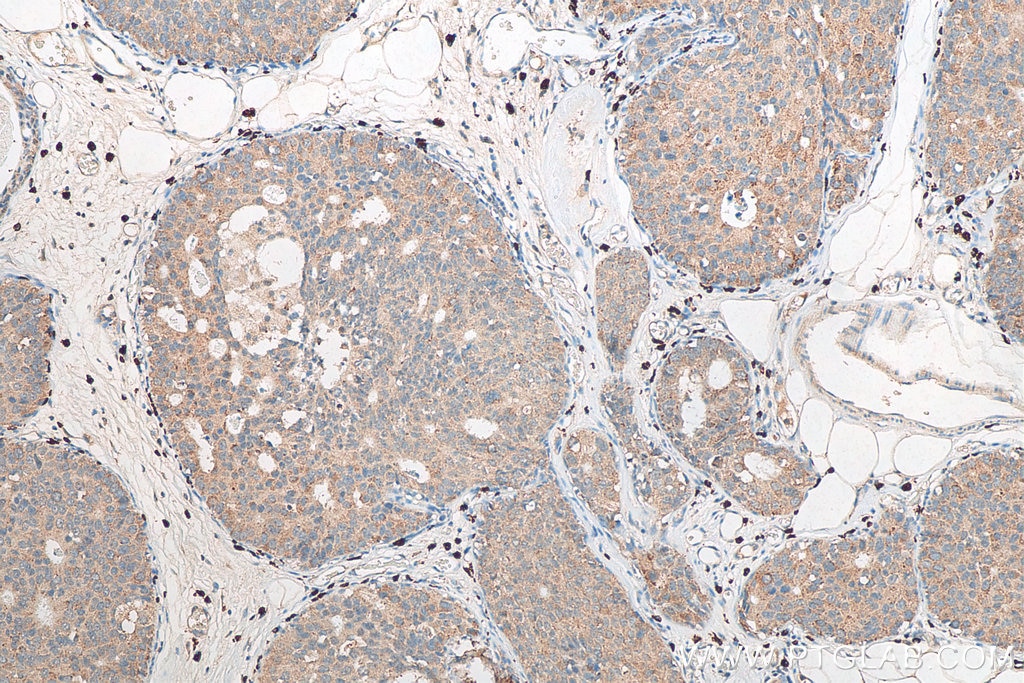 Immunohistochemistry (IHC) staining of human breast cancer tissue using CIP2A Polyclonal antibody (23199-1-AP)