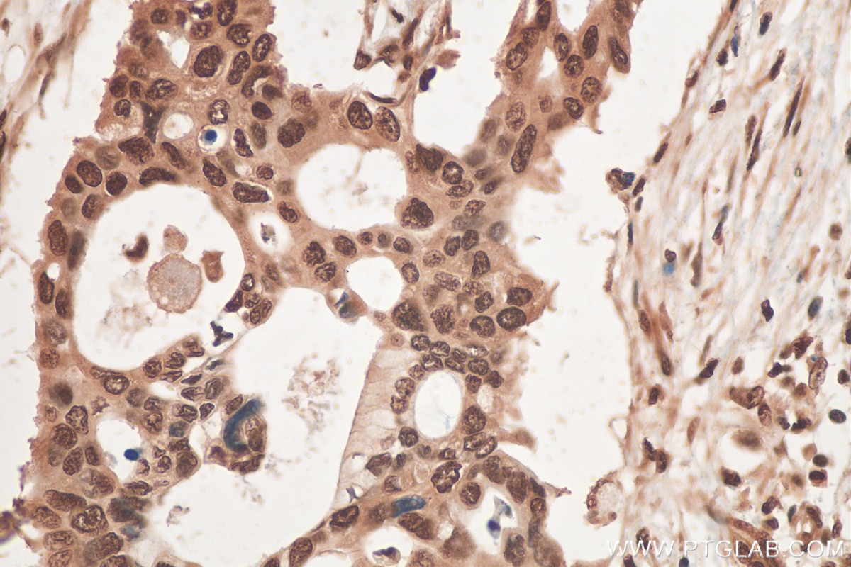 Immunohistochemistry (IHC) staining of human pancreas cancer tissue using CIRBP Polyclonal antibody (10209-2-AP)