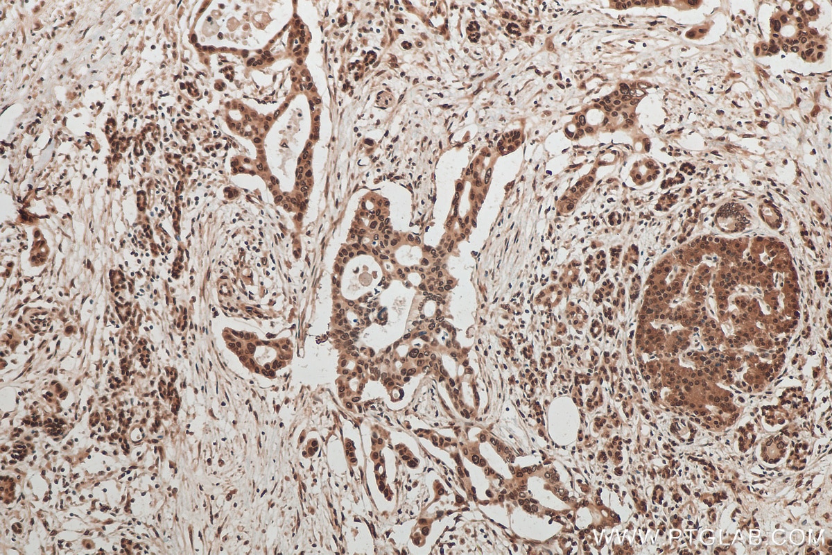 Immunohistochemistry (IHC) staining of human pancreas cancer tissue using CIRBP Polyclonal antibody (10209-2-AP)