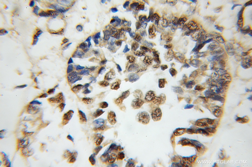 Immunohistochemistry (IHC) staining of human breast cancer tissue using CIRBP Polyclonal antibody (10209-2-AP)