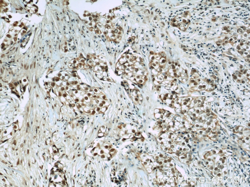 Immunohistochemistry (IHC) staining of human breast cancer tissue using CIRBP Polyclonal antibody (10209-2-AP)