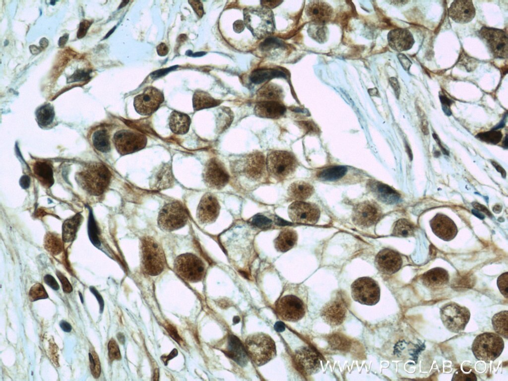 Immunohistochemistry (IHC) staining of human breast cancer tissue using CIRBP Polyclonal antibody (10209-2-AP)