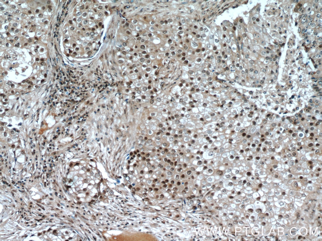 Immunohistochemistry (IHC) staining of human breast cancer tissue using CIRBP Monoclonal antibody (60025-1-Ig)