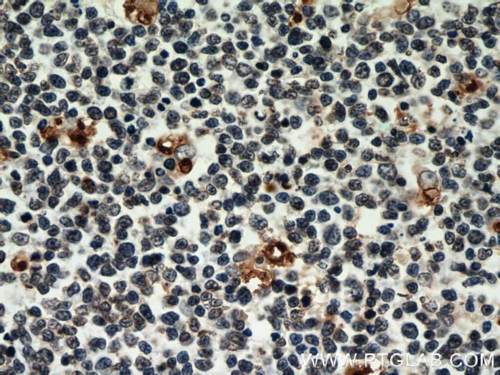 Immunohistochemistry (IHC) staining of human tonsillitis tissue using CIRBP Monoclonal antibody (60025-2-Ig)