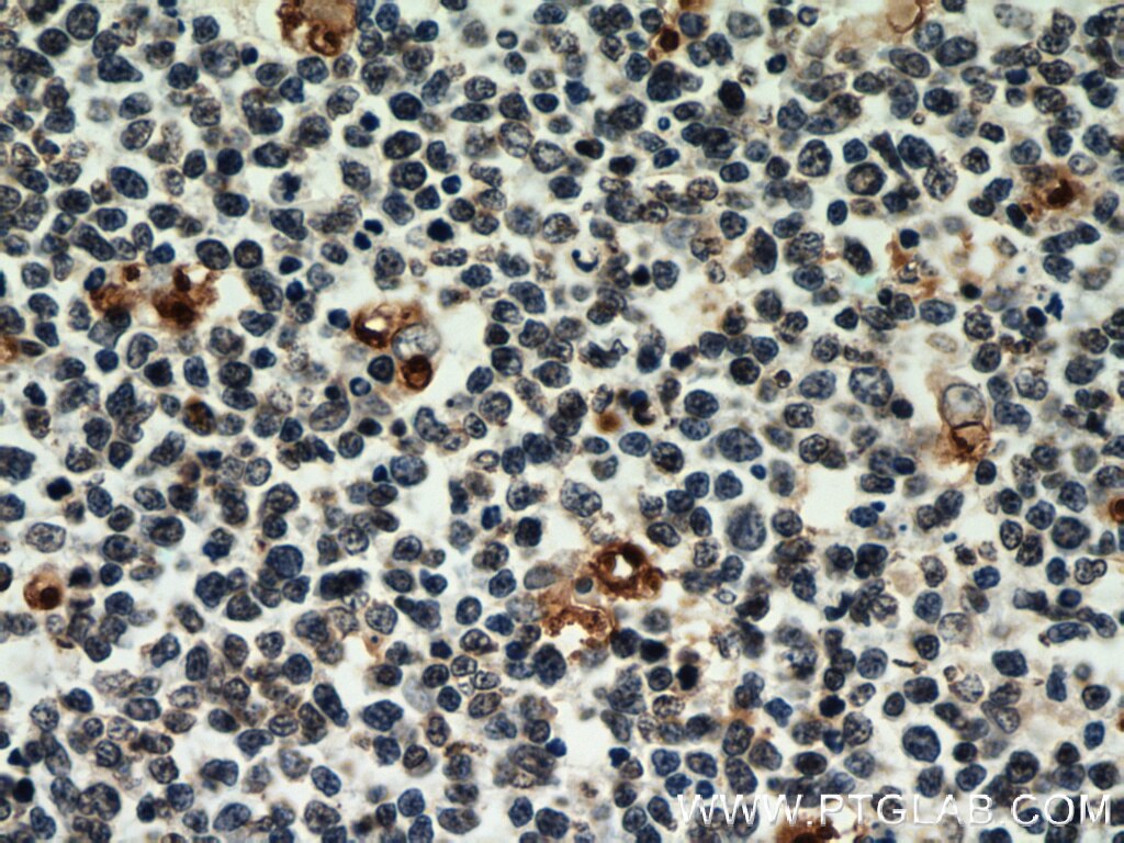 IHC staining of human tonsillitis using 60025-2-Ig