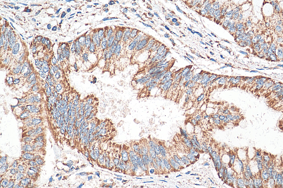 IHC staining of human pancreas cancer using 68030-1-Ig