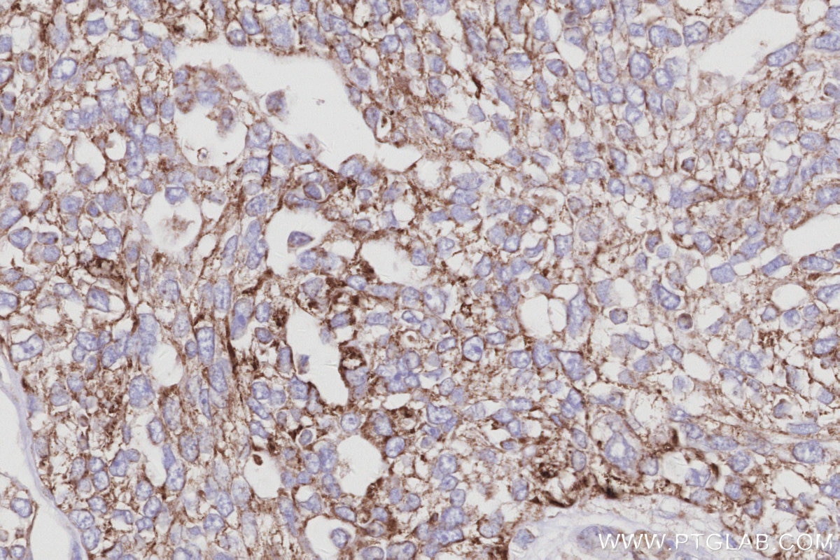 Immunohistochemistry (IHC) staining of human ovary cancer tissue using CISD1 Monoclonal antibody (68030-1-Ig)