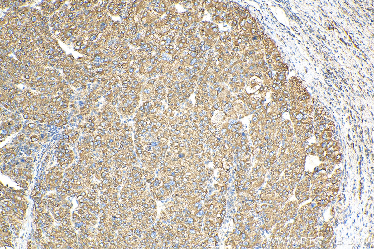 Immunohistochemistry (IHC) staining of human liver cancer tissue using CISD2 Polyclonal antibody (13318-1-AP)