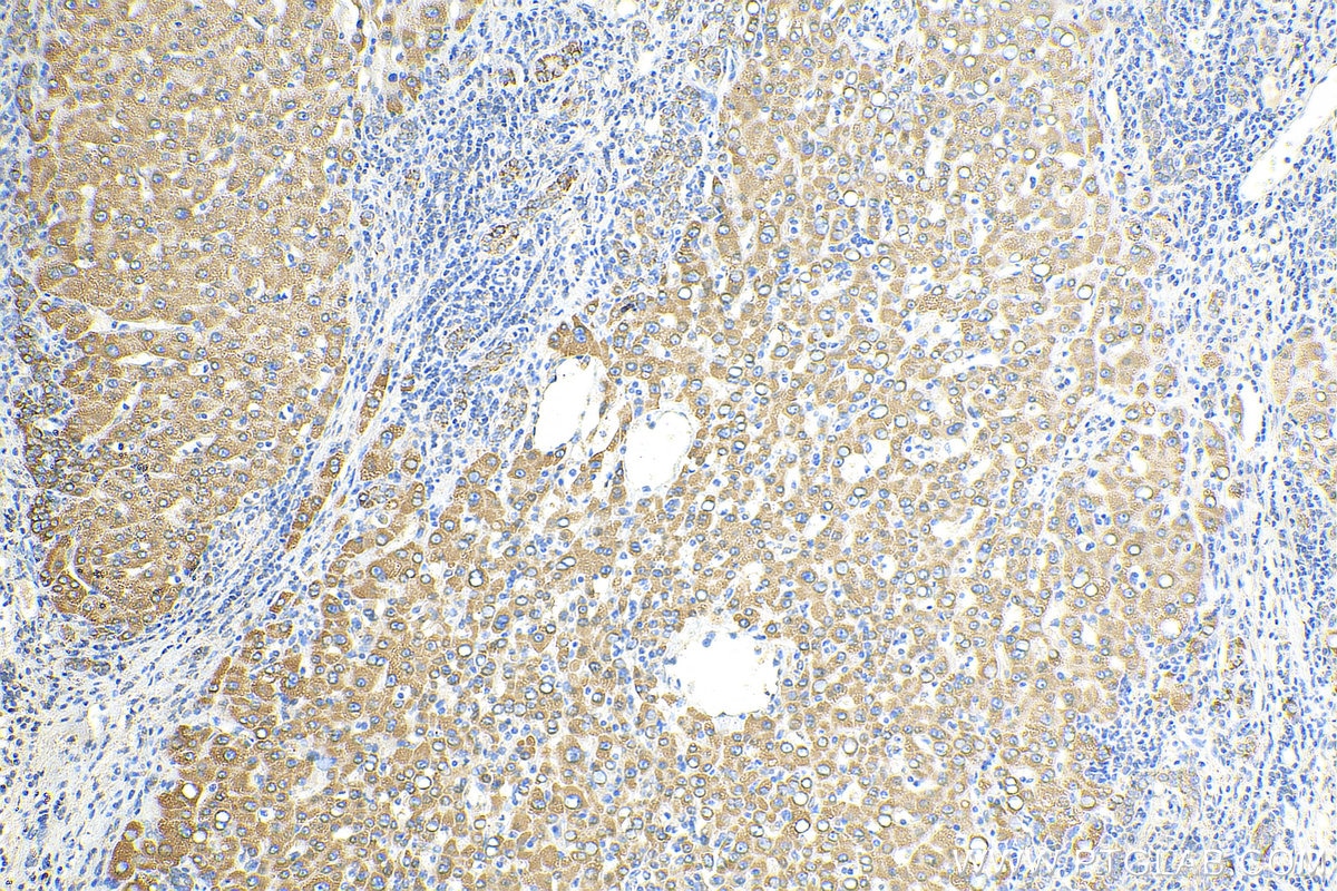 Immunohistochemistry (IHC) staining of human liver cancer tissue using CISD2 Polyclonal antibody (13318-1-AP)