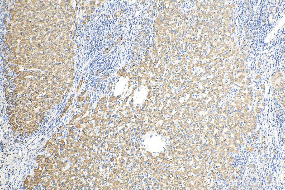 IHC staining of human liver cancer using 13318-1-AP