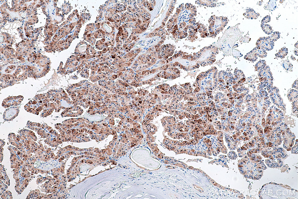 Immunohistochemistry (IHC) staining of human thyroid cancer tissue using CITED1 Polyclonal antibody (26999-1-AP)