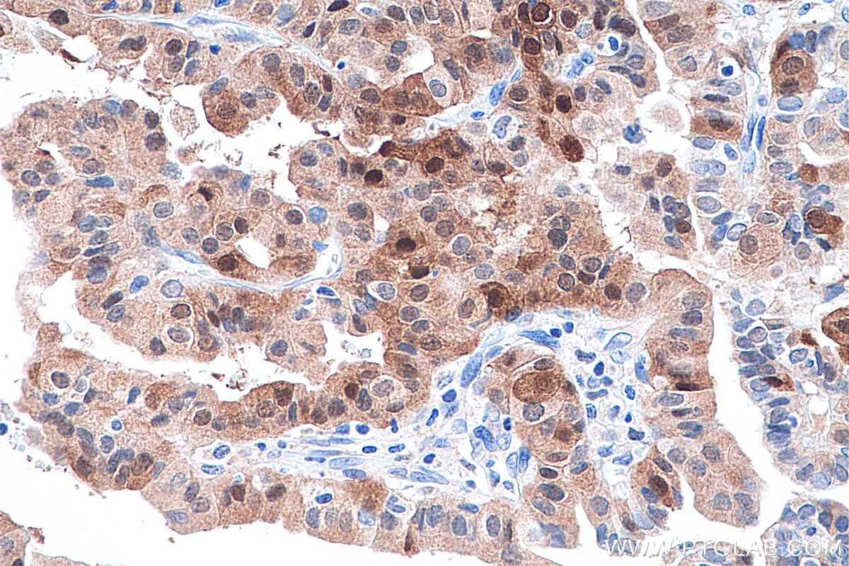 Immunohistochemistry (IHC) staining of human thyroid cancer tissue using CITED1 Polyclonal antibody (26999-1-AP)