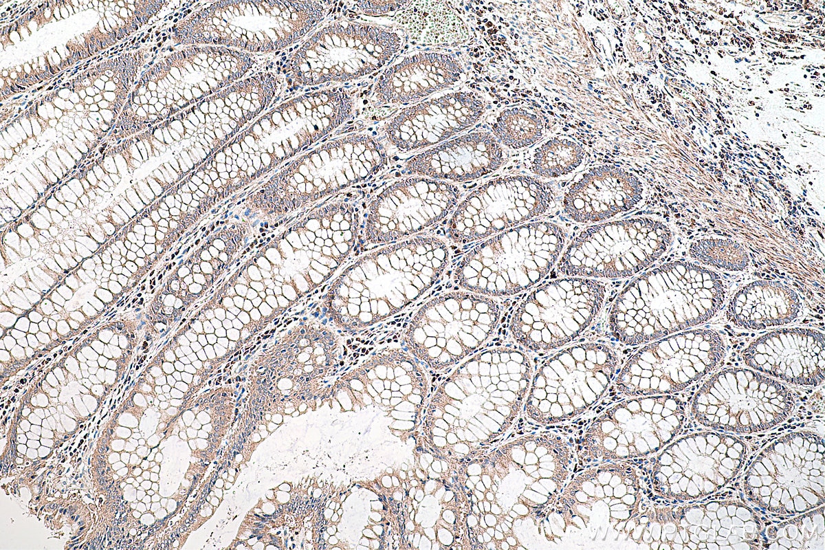 Immunohistochemistry (IHC) staining of human colon cancer tissue using CITED1 Polyclonal antibody (26999-1-AP)