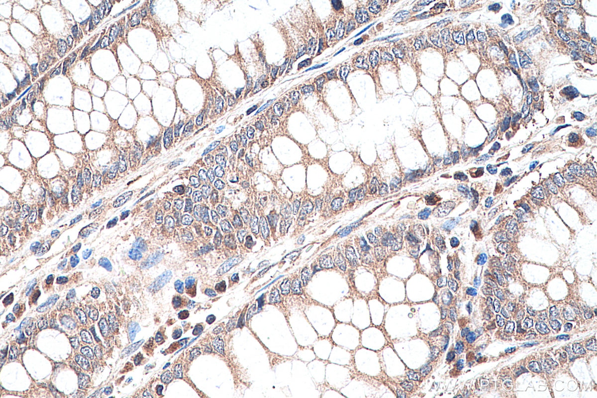 IHC staining of human colon cancer using 26999-1-AP