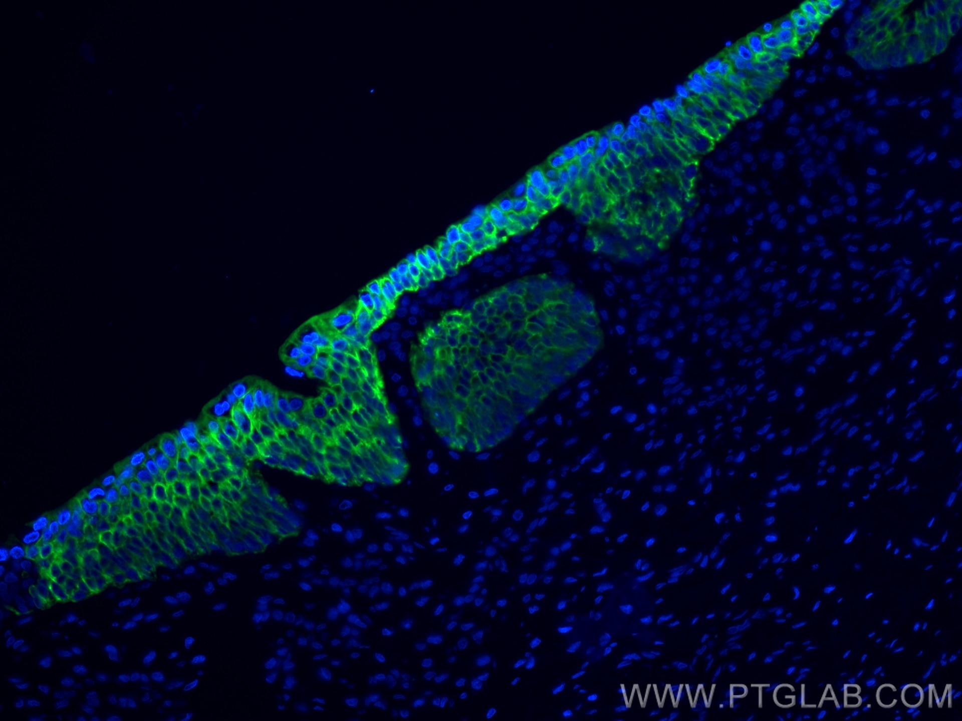 Immunofluorescence (IF) / fluorescent staining of human prostate cancer tissue using Cytokeratin 7 Monoclonal antibody (66483-1-Ig)