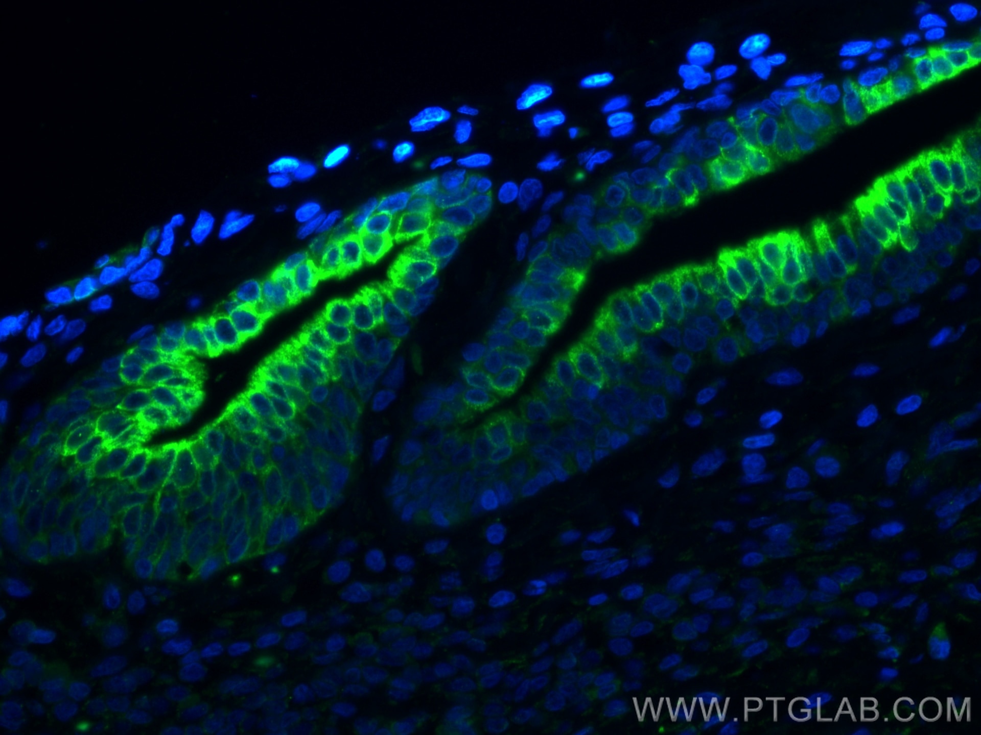 Immunofluorescence (IF) / fluorescent staining of human prostate cancer tissue using Cytokeratin 7 Monoclonal antibody (66483-1-Ig)