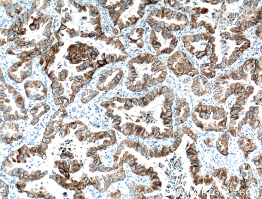 Immunohistochemistry (IHC) staining of human lung cancer tissue using Cytokeratin 7 Monoclonal antibody (66483-1-Ig)