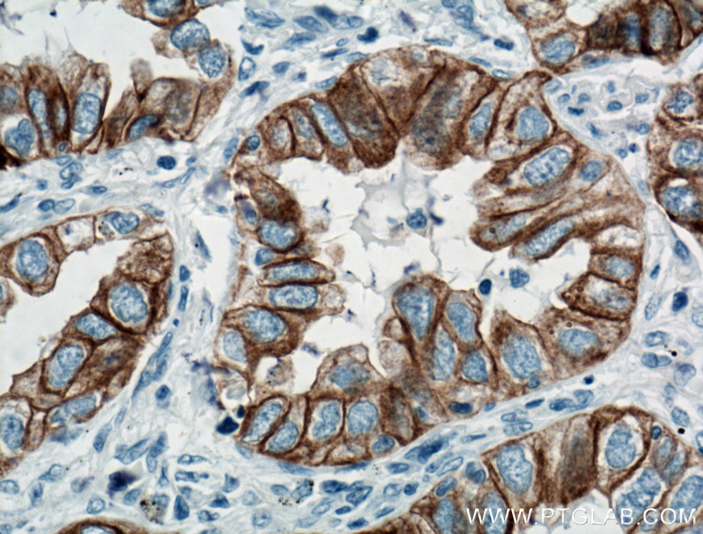 Immunohistochemistry (IHC) staining of human lung cancer tissue using Cytokeratin 7 Monoclonal antibody (66483-1-Ig)
