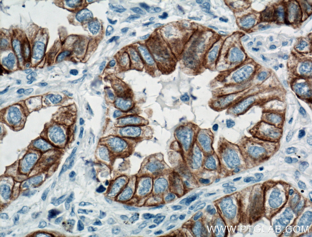 IHC staining of human lung cancer using 66483-1-Ig