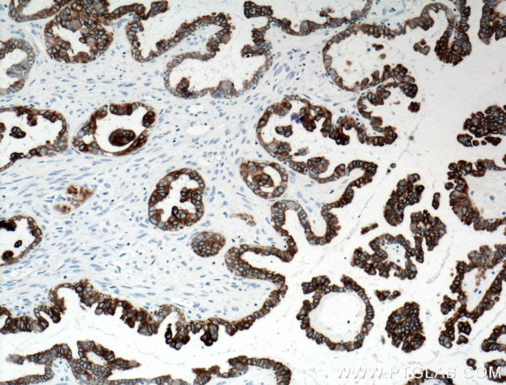 Immunohistochemistry (IHC) staining of human ovary tumor tissue using Cytokeratin 7 Monoclonal antibody (66483-1-Ig)
