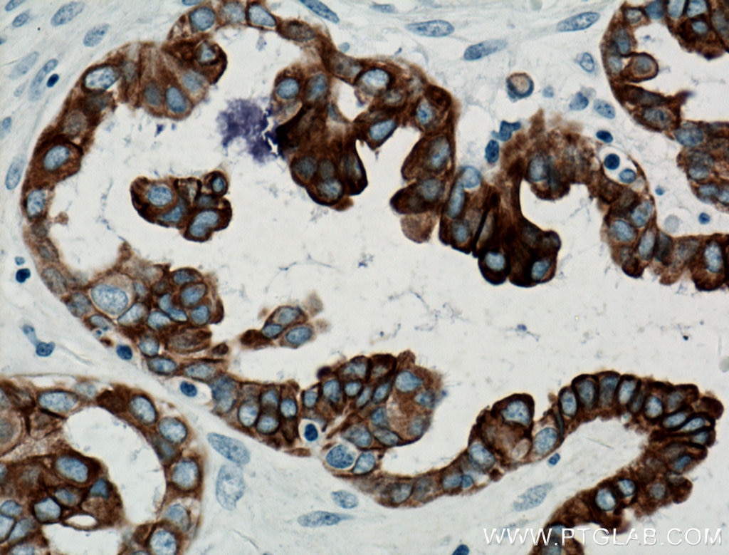 Immunohistochemistry (IHC) staining of human ovary tumor tissue using Cytokeratin 7 Monoclonal antibody (66483-1-Ig)