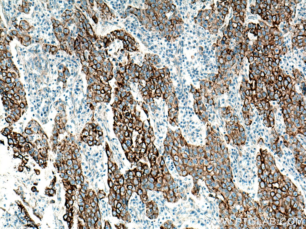 Immunohistochemistry (IHC) staining of human breast cancer tissue using Cytokeratin 7 Monoclonal antibody (66483-1-Ig)