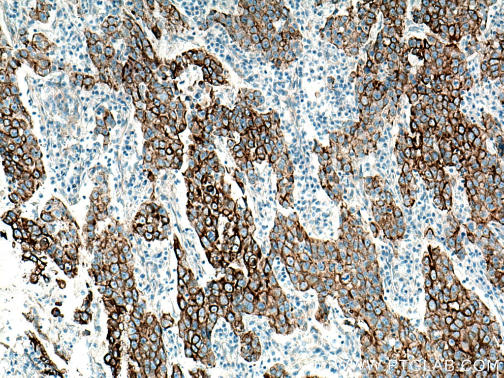 IHC staining of human breast cancer using 66483-1-Ig