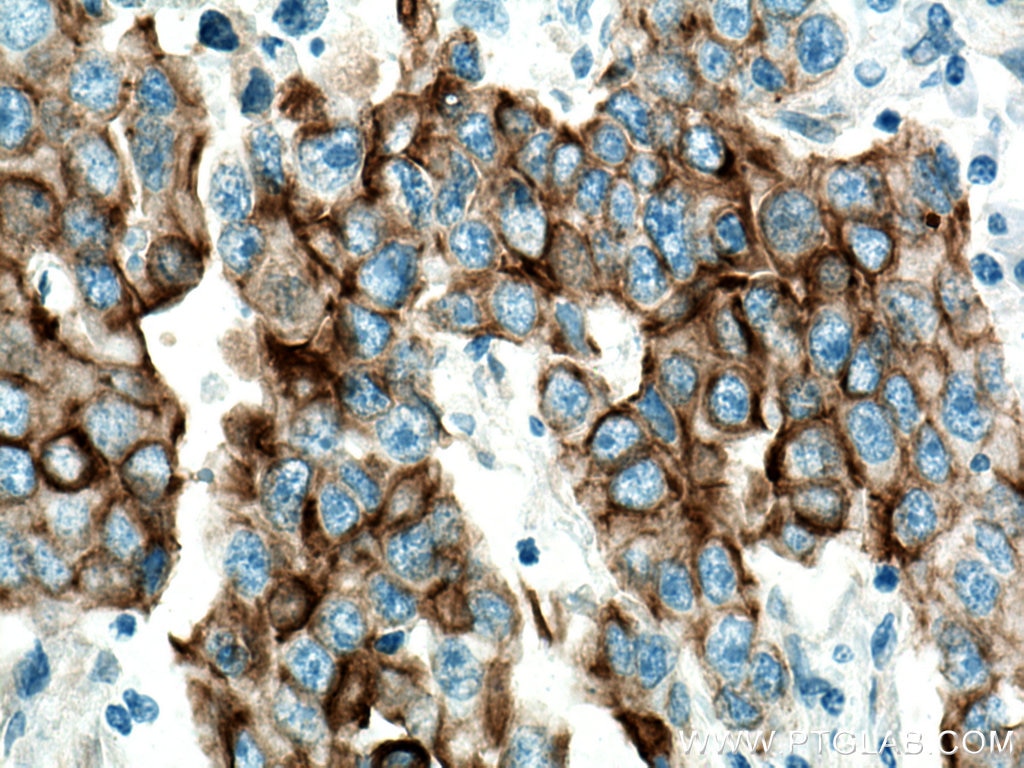 Immunohistochemistry (IHC) staining of human breast cancer tissue using Cytokeratin 7 Monoclonal antibody (66483-1-Ig)