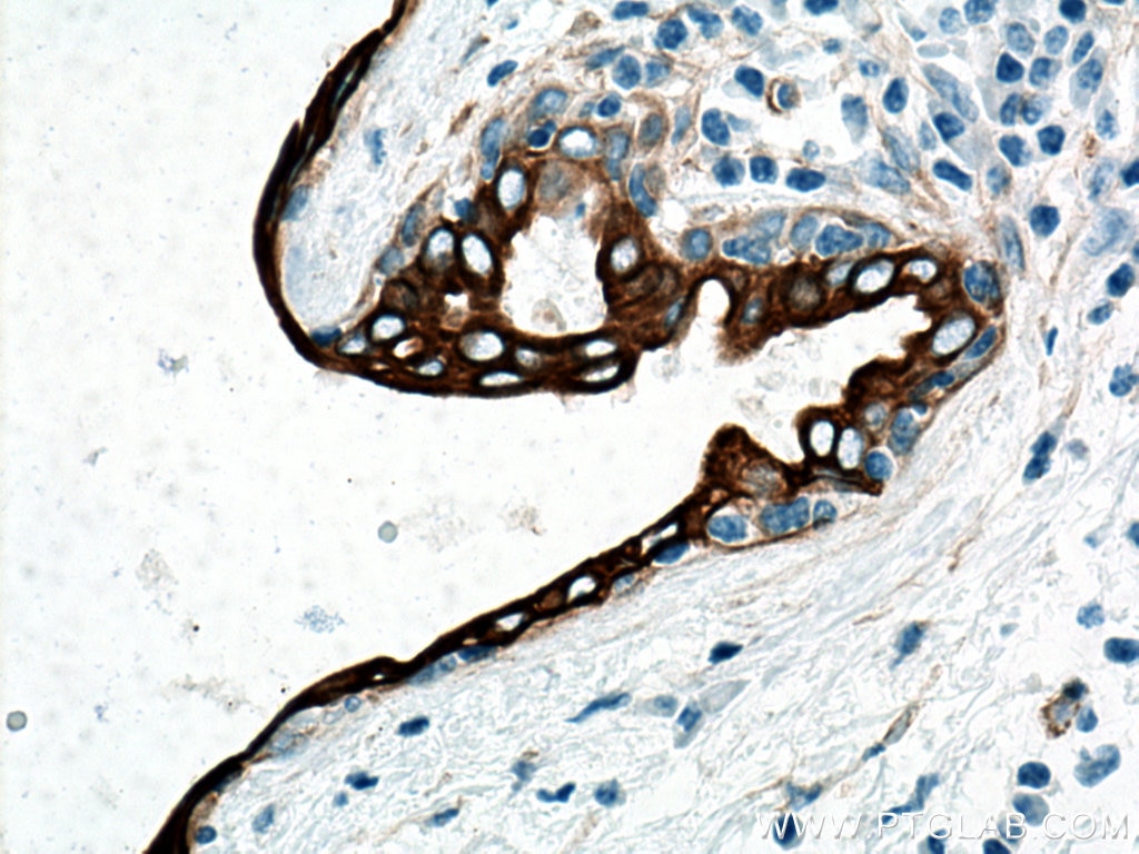 Immunohistochemistry (IHC) staining of human breast cancer tissue using Cytokeratin 7 Monoclonal antibody (66483-1-Ig)