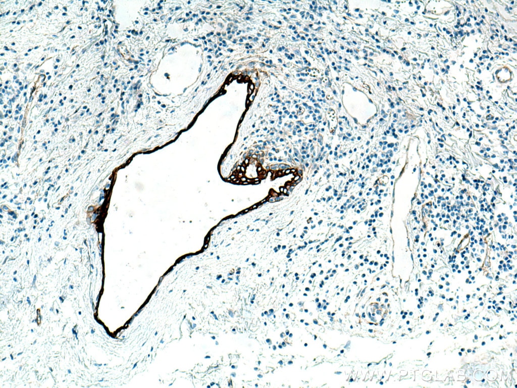 Immunohistochemistry (IHC) staining of human breast cancer tissue using Cytokeratin 7 Monoclonal antibody (66483-1-Ig)