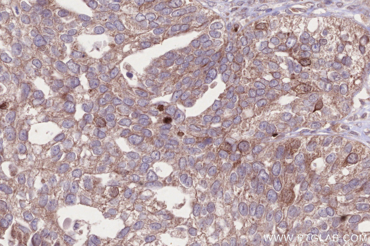 Immunohistochemistry (IHC) staining of human ovary cancer tissue using CKAP2L Polyclonal antibody (17143-1-AP)