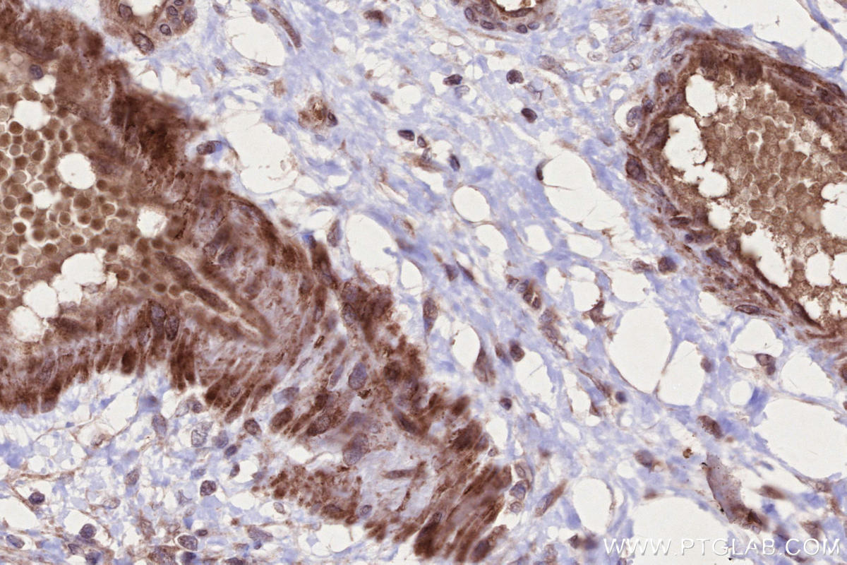 Immunohistochemistry (IHC) staining of human ovary cancer tissue using CKAP2L Polyclonal antibody (17143-1-AP)