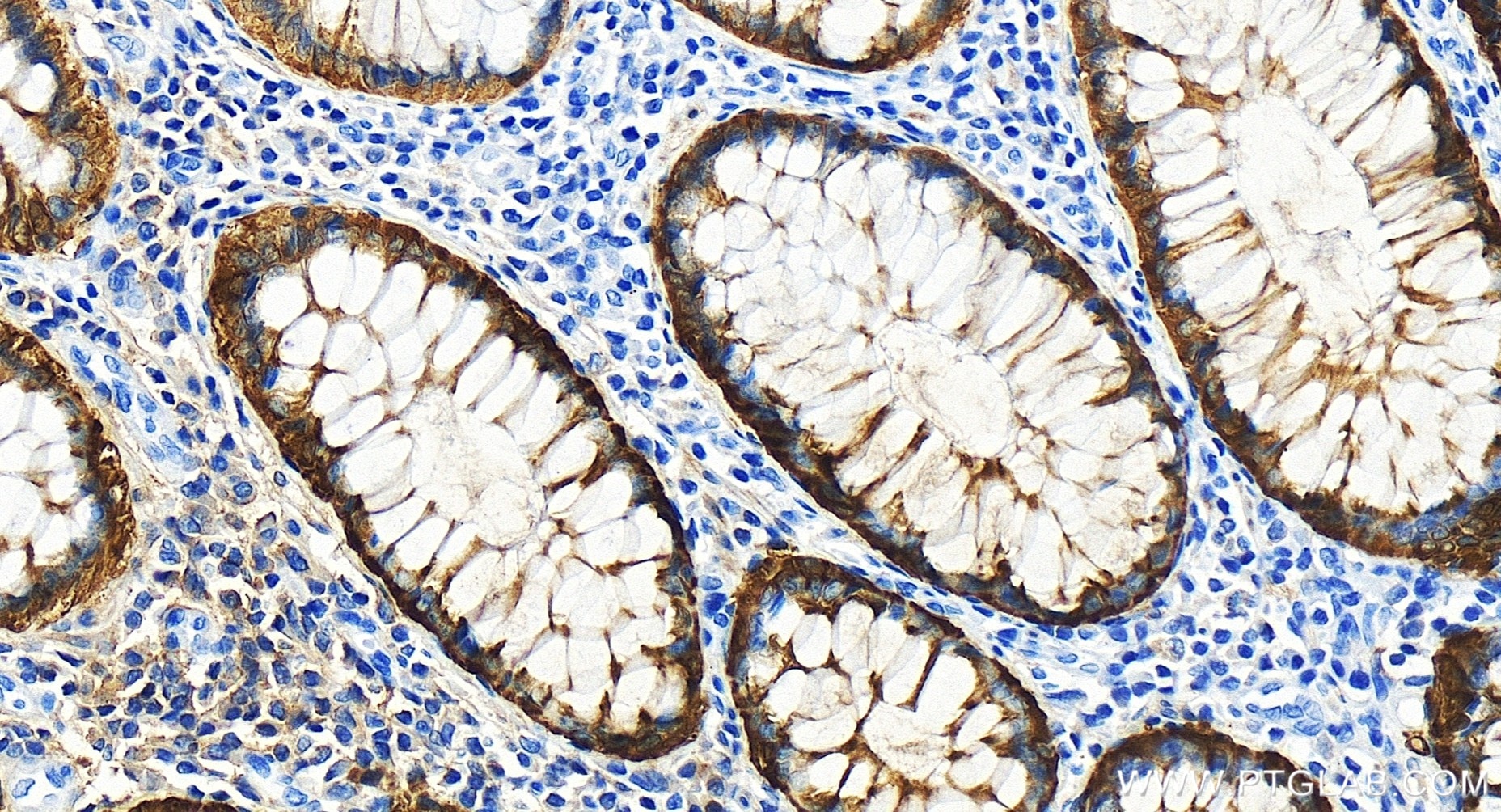 Immunohistochemistry (IHC) staining of human colon cancer tissue using CKB Recombinant antibody (83522-5-RR)