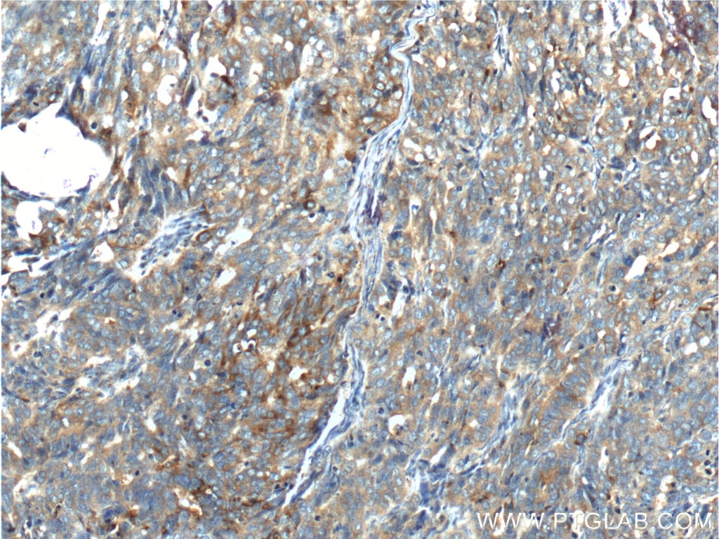 Immunohistochemistry (IHC) staining of human ovary tumor tissue using CKB-Specific Polyclonal antibody (18713-1-AP)