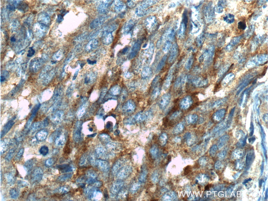 Immunohistochemistry (IHC) staining of human ovary tumor tissue using CKB-Specific Polyclonal antibody (18713-1-AP)