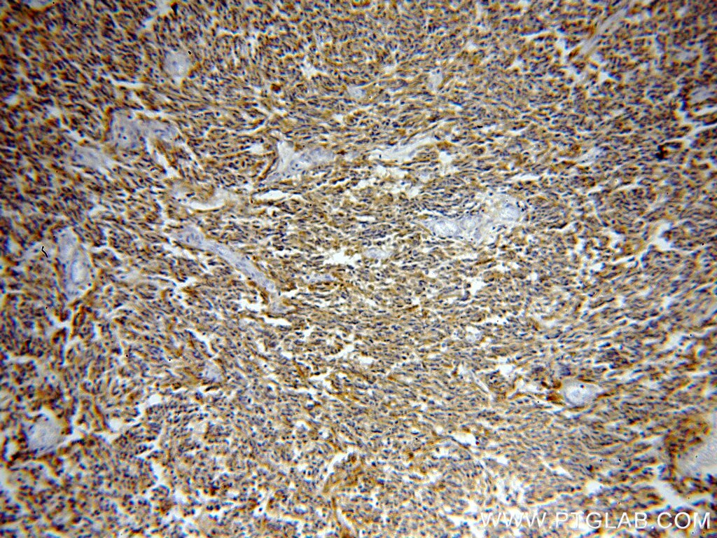 Immunohistochemistry (IHC) staining of human gliomas tissue using CKB-Specific Polyclonal antibody (18713-1-AP)