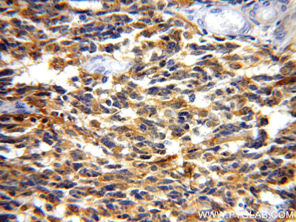 IHC staining of human gliomas using 18713-1-AP